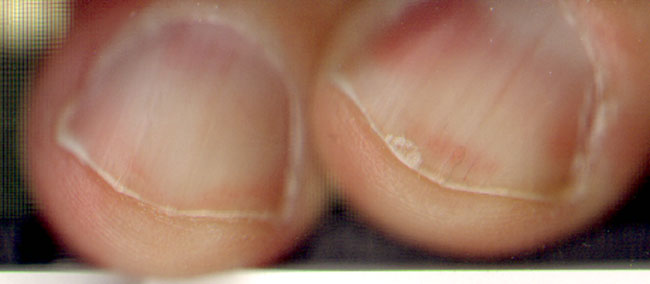 slordig geknipte nagels