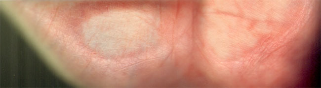 palm