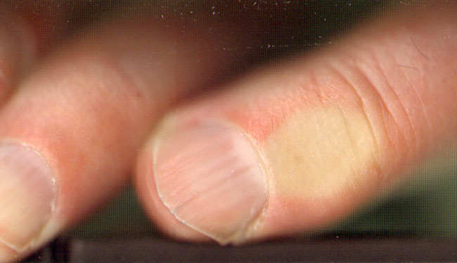 nagelhoekje