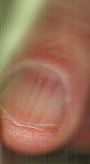 droge vinger