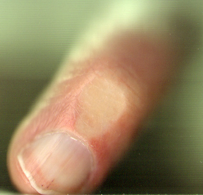 vinger