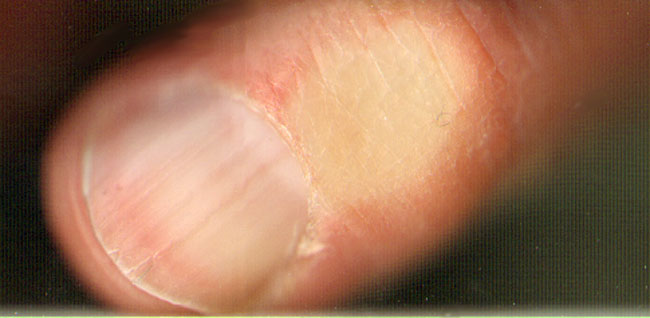 droge wintervinger