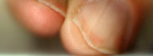 slordig geknipte nagels