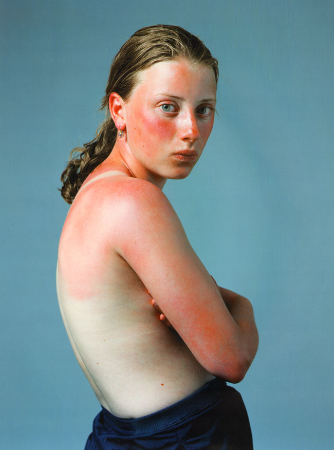 roodverbrand...