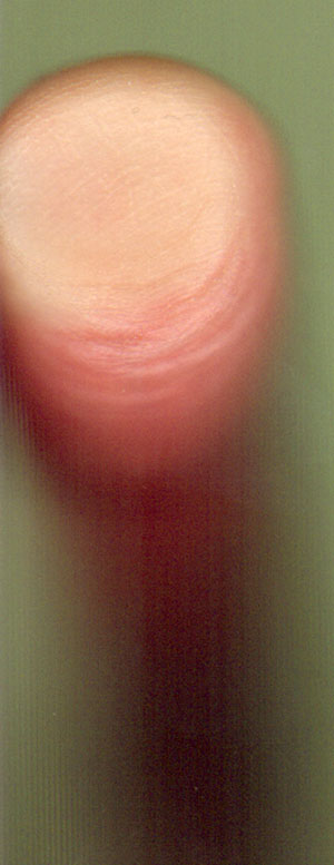 rimpelvinger...