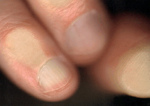 drie vingers…